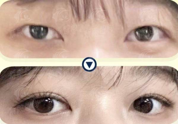 四、山东大学第二医院整形科:求美者真实分享与项目价格参考