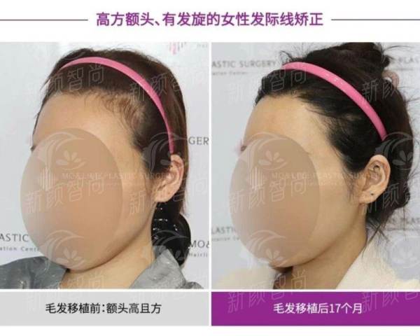 河南整形美容医院刘凤斌无假体生态隆鼻，技术特色大揭秘！附价格表&案例展示，新颜智尚小程序一键预约！