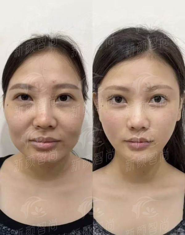 想找杭州清锴李保锴做鼻子？看这份隆鼻风格优势特点与案例，地址价格表全公开，新颜智尚小程序预约省心快速