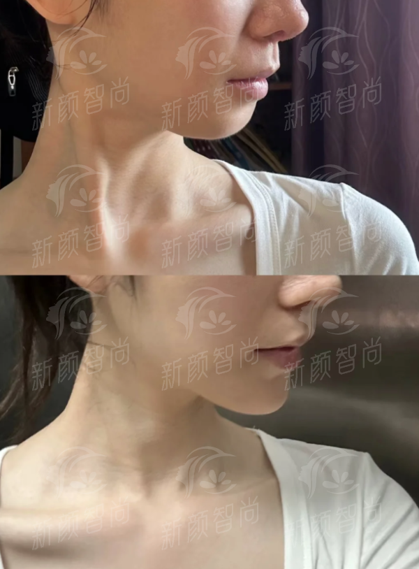 重庆星荣刘正茂PEEK人工骨眶下缘填充怎么样？医生简介&价格表&案例大揭秘，新颜智尚小程序一键预约！