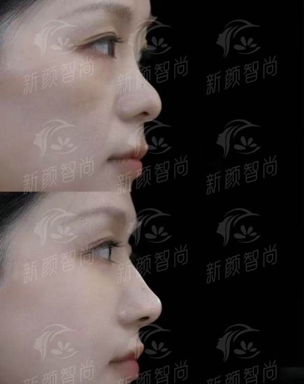 上海鼻整形必看！伯思立韩嘉毅医生，从业14年，鼻尖下垂矫正口碑如何？线上预约已开启！-24小时新颜智尚小程序预约