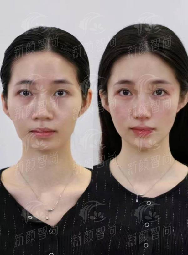 二、特殊专项技术：揭秘“长效提拉”与“自然填充”的奥秘