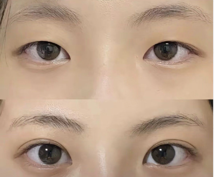 何镇宇医生双眼皮诊疗的核心优势，多维度方案设计，适配不同眼部基础