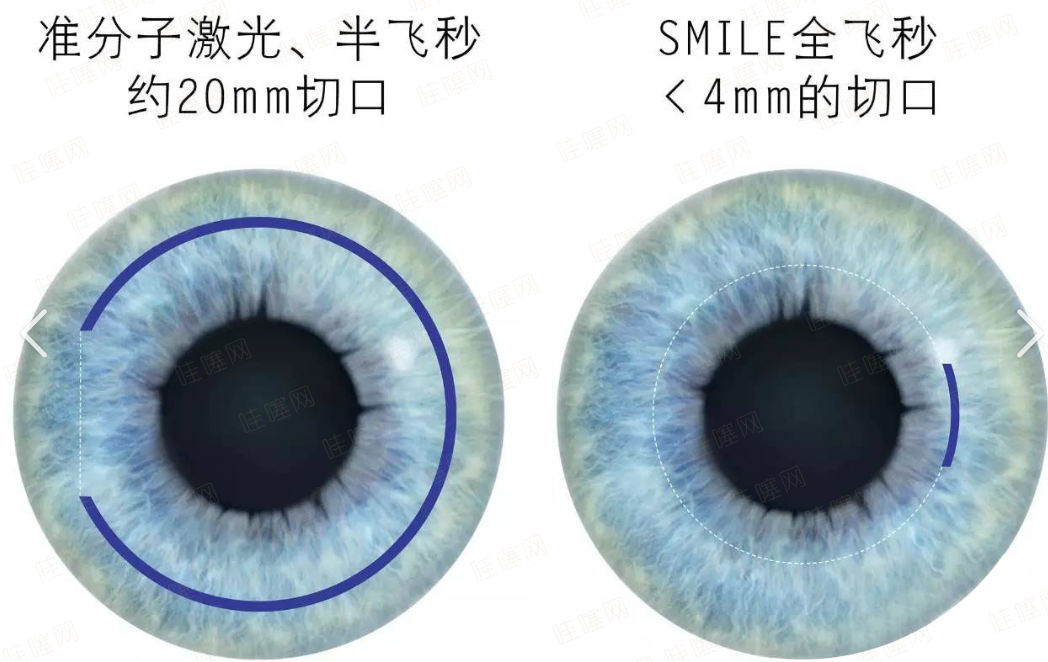 一、深圳友华普惠眼科半飞秒技术：适配多样近视需求